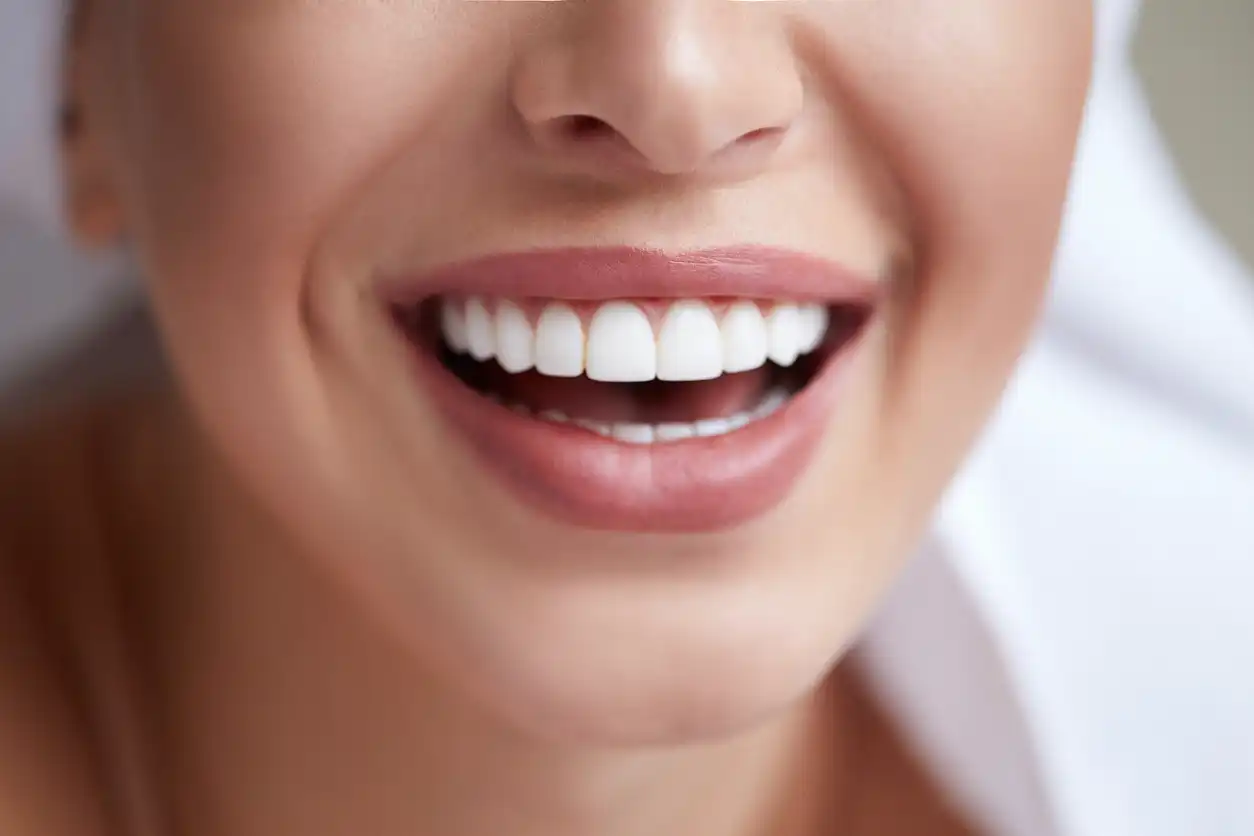 Should You Choose Professional or Over-the-Counter Whitening